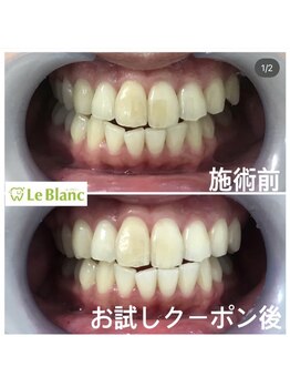 ルブラン 奈良店(Le Blanc)/笑顔を輝かせるホワイトニング