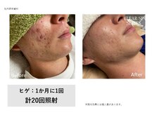 ティエル(TieLu)/ヒゲ脱毛