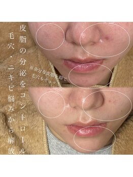 ソワ 吉塚店(soi)/皮脂をコントロール!