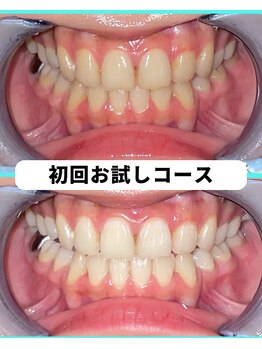ホワイトニングビューティー 吉祥寺店/ホワイトニング 初来店