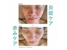 【フェイシャル・ハーブピーリング・よもぎ蒸し】EL spa中村橋【エルスパ】の雰囲気（大人気のクリスティーナで肌に優しいハーブピーリング）