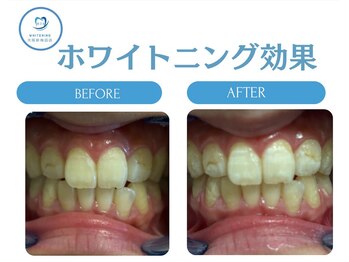 R24 梅田店/ホワイトニング効果