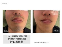 ティエル(TieLu)/ヒゲ脱毛