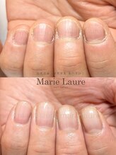 マリーロール 淀屋橋本店(Marie Laure)/自爪育成/深爪矯正/ネイルケア