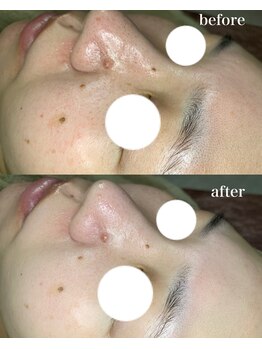 アルティ 福岡大名店(ARTI,)/毛穴洗浄