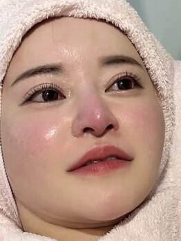 ニニ(nini)の写真/【渋谷駅A2出口徒歩6分】“生”エクソソーム導入で毛穴も肌質も格上げ◎透明感ハリツヤたまご肌に大変身