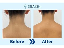 ストラッシュ 新宿西口店(STLASSH)/【ストラッシュ】お客様の施術例