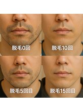 アイランド 川崎店(island)/【ヒゲ脱毛ビフォーアフター】