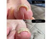 まき爪晴れるの雰囲気（痛みはその場でなくなります。）