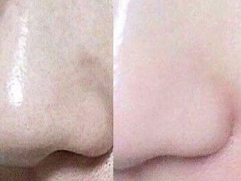 モアスキン 南青山店(MORE SKIN)/毛穴つるん