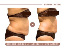 イエス マイサロン(yes My Salon)/脂肪冷却＋痩身施術症例
