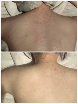 マハロ(mahalo)/背中ニキビケア