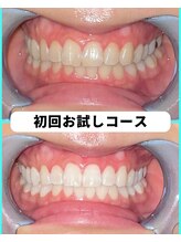 ホワイトニングビューティー 吉祥寺店/ホワイトニング　初来店
