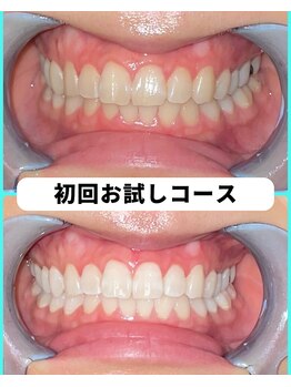 ホワイトニングビューティー 吉祥寺店/ホワイトニング 初来店