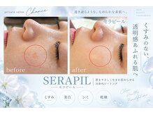 シャンス(Chance)の雰囲気(症例)