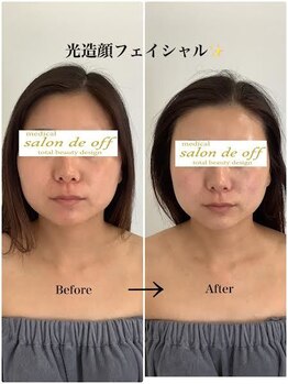 メディカルサロンドオフ 堺東店(medical salon de off)/光造顔フェイシャル★　施術前後
