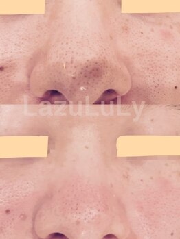 ラズリ(LazuLuLy)の写真/【数々の受賞歴を持つ実力店】ハイドラ毛穴洗浄¥5500!10年以上悩み続けた毛穴開き/黒ずみ/皮脂/乾燥肌に◎