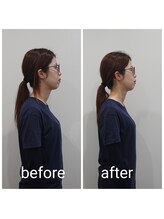 ベラージュ/小顔リフト・フレームアップケア