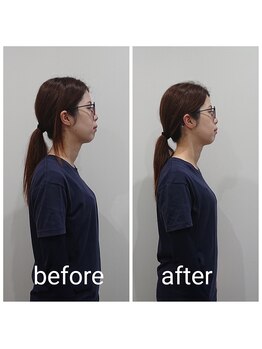 ベラージュ/小顔リフト・フレームアップケア