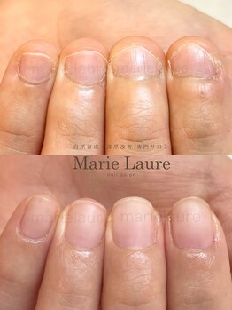 マリーロール 淀屋橋本店(Marie Laure)/自爪育成/深爪矯正/ネイルケア