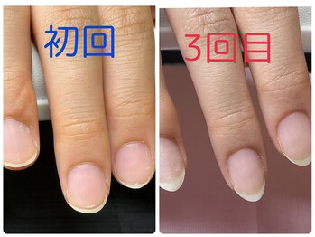 ケアビューティサロン(care beauty salon)/育爪ジェルコース