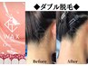 【ダブル脱毛】　匠道ワックス＆美容脱毛◆うなじ襟足脱毛　特別価格4400円