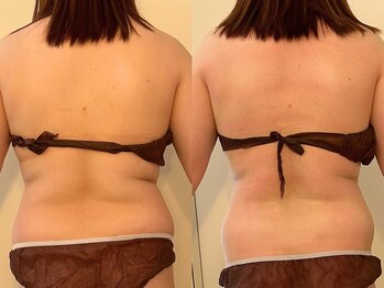 ヒールパーム(Heal Palm)/ウルトランスフォーマー1回★