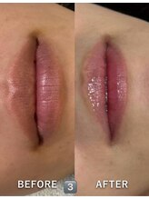 メディカルエース(MedicalAce)/ROMA PINK