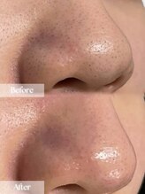 アップユー(UPU)/ハーブピーリング　