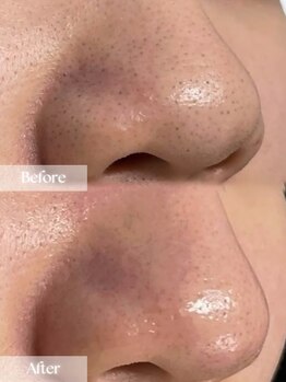 アップユー(UPU)/ハーブピーリング