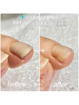 巻き爪補正【初回の変化】