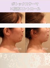 エン 橿原店(en)/40代、気になる口元の脂肪を解消