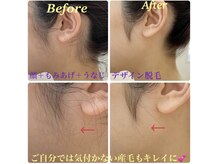 ラボーテ(La Beaute)/垢抜ける★顔全体&首うなじ脱毛