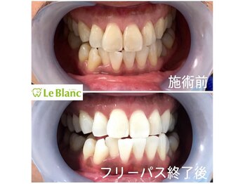ルブラン 奈良店(Le Blanc)/ストレスフリーで歯を白く！