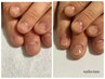 【男性/ハンド】バレずに深爪矯正/初回体験￥31900→