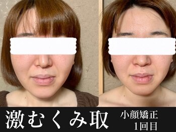 メル(mer)/小顔矯正