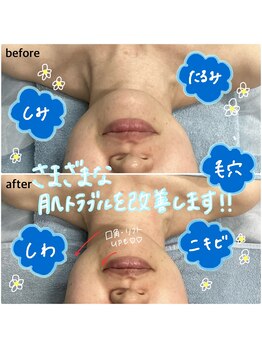 ウルーフ(ulu-fu)/BBLフェイシャル