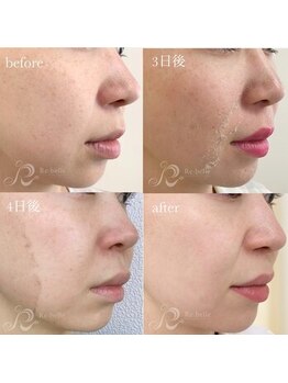 ココラーレ(cocorare)/日暮里/剥離あり本気の肌質改善