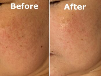 スイ 昭島店(Sui)/ハーブピーリング/シミケア/美白