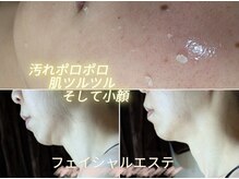 スノードロップ(snowdrop)/毛穴/にきび/小顔/フェイシャル