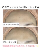 ココネイル 板山店(coco nail)/光フェイシャル×ポレーション