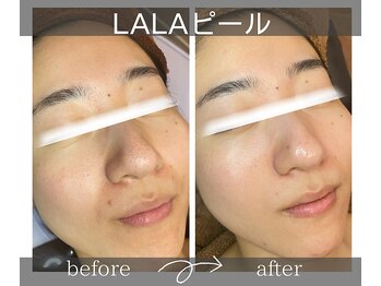 サロンドボーテアリス (Salon de beaute ALICE)/韓国美肌管理LALAピール