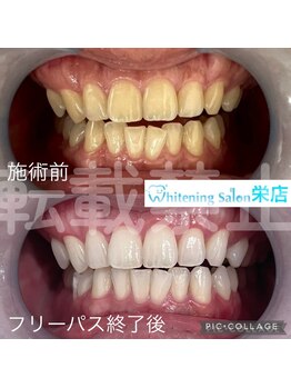 ホワイトニングサロン 名古屋 栄店/【ホワイトニング】