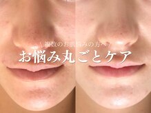 ルアナアイナ 大分/ハーブピーリング(5)