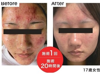 トリアングル(TLIENGLE)/最新ポレーションビフォアフ