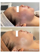 ジュエッテ(jouete)/肌質が変わる！