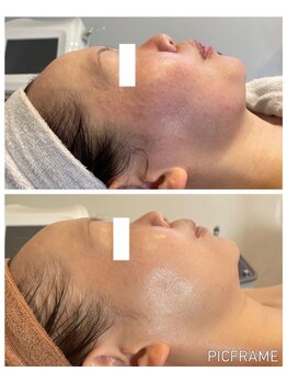 ジュエッテ(jouete)/肌質が変わる！