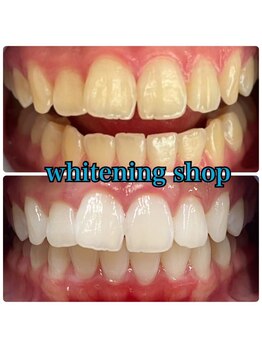 ホワイトニングショップ 高知店/ホワイトニング比較写真♪
