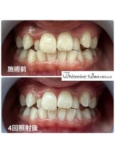 ホワイトニングサロン 京都烏丸店/ホワイトニング施術例