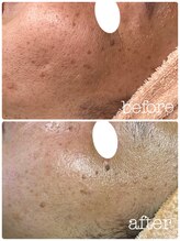 彩ビューティーラボ(彩 Beauty Labo)/マイクロニードルピーリング